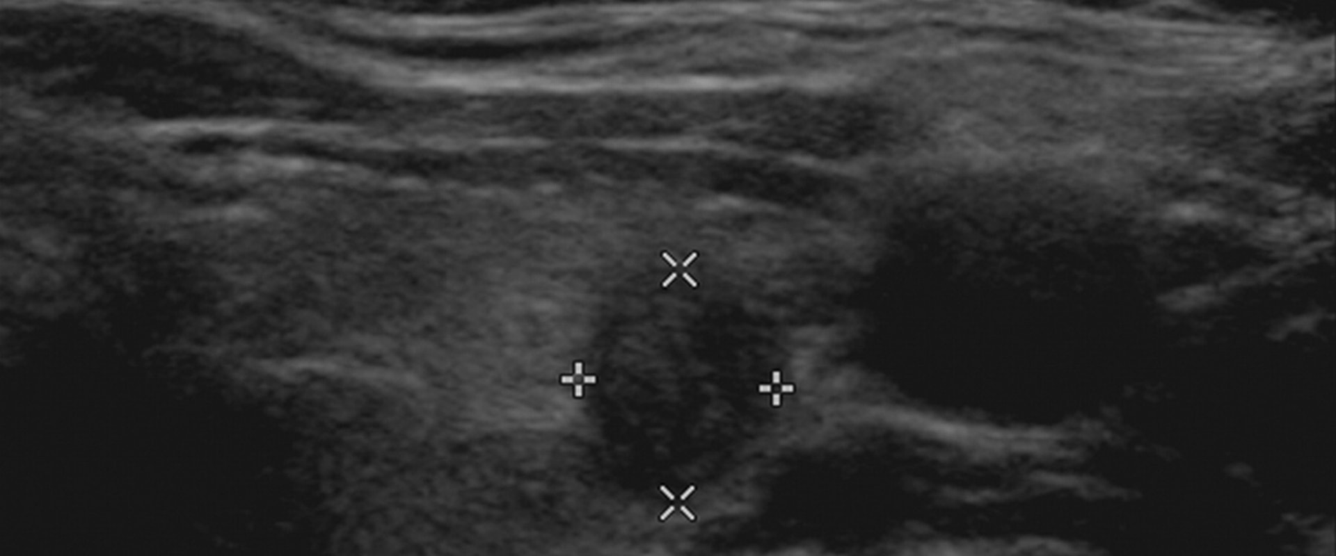 what-does-thyroid-cancer-look-like-on-ultrasound